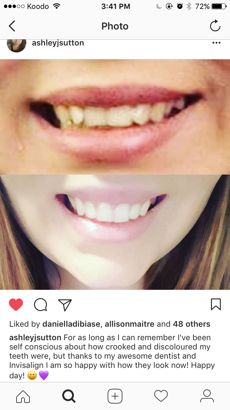 invisalign canada